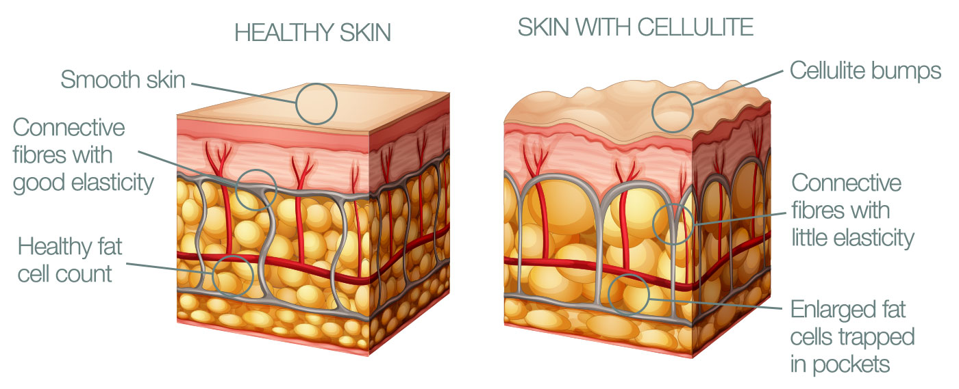 Cellulite-formation